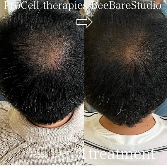 頭頂部の薄毛の改善例