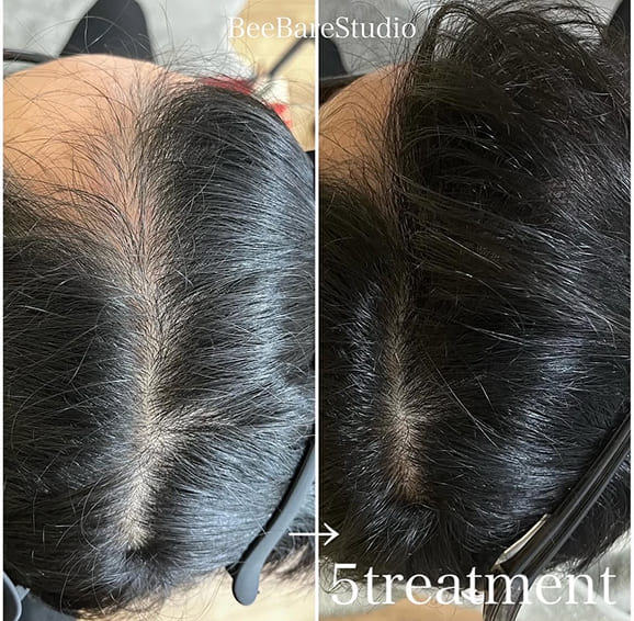 頭頂部分け目の薄毛改善例