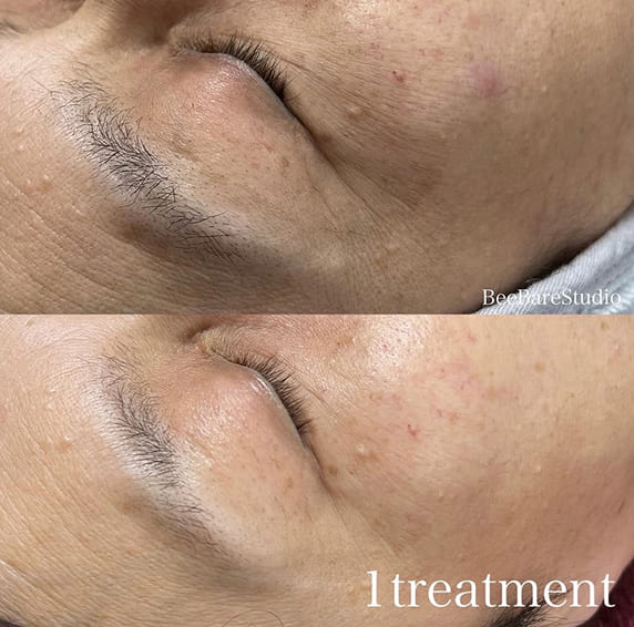 シミやシワ改善とトーンアップの例