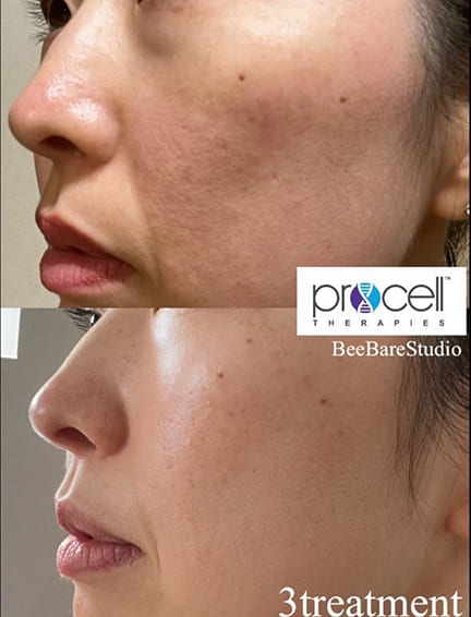 ニキビ跡や凸凹肌の改善例