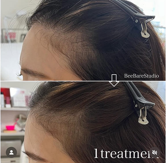 生え際の薄毛改善例