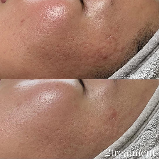肌質改善 施術2回のビフォーアフター（20代女性）